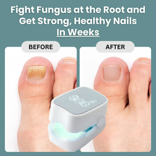 ClearNail Pro™ - Nail Fungus Laser Device